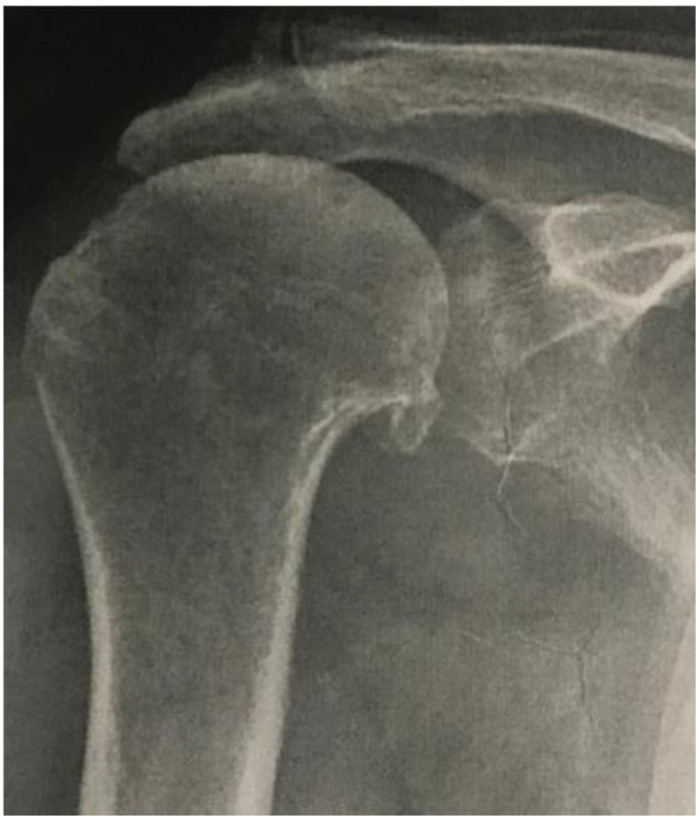 Lipoma of the Teres Minor in Rotator Cuff Arthropathy-A Case Report.