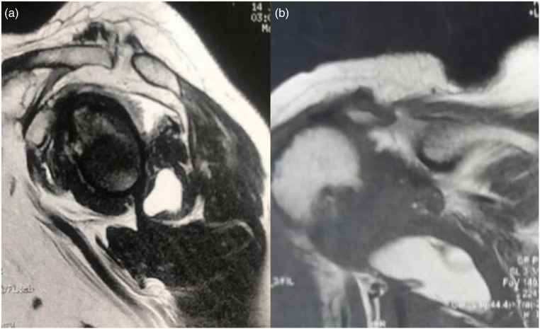 Lipoma of the Teres Minor in Rotator Cuff Arthropathy-A Case Report.