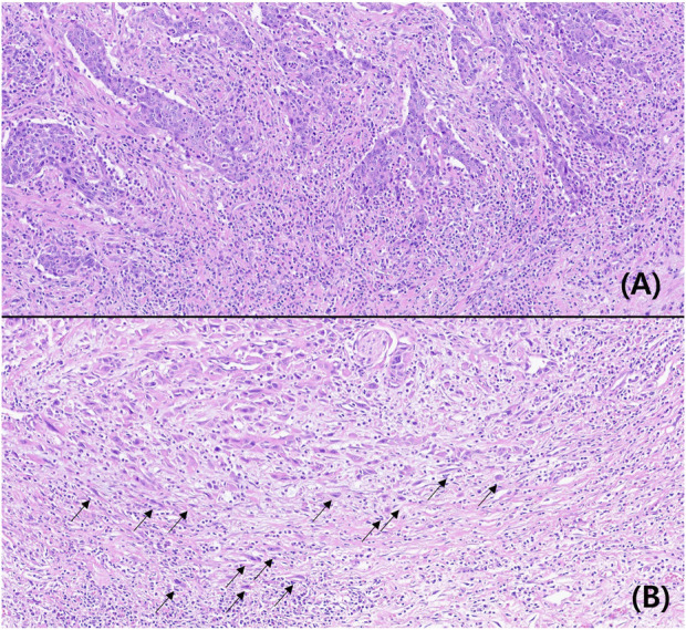 Tumor budding as a predictor of disease-free survival in patients with cholangiocarcinoma.