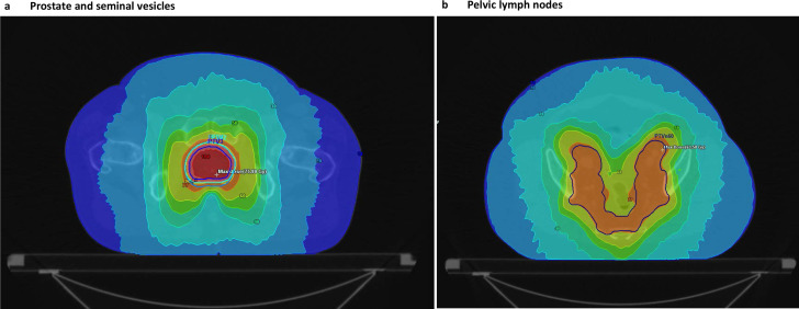 Outcomes following external beam radiotherapy to the prostate and pelvic lymph nodes in addition to androgen deprivation therapy in non-metastatic prostate adenocarcinoma with regional lymph node involvement: a retrospective cohort study.