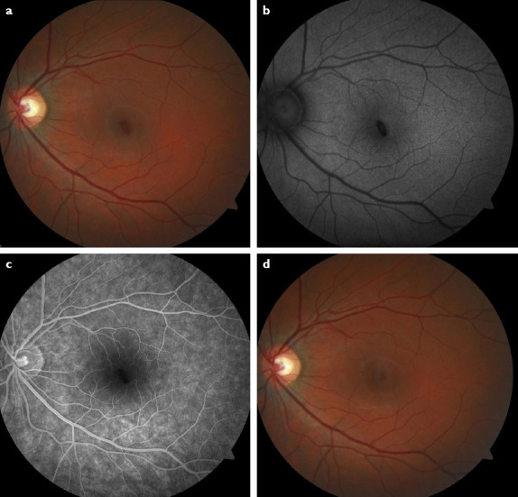 Idiopathic Unilateral Foveal Hemorrhage in a Young Woman Without Precipitating Factors: Evaluation with Optical Coherence Tomography Angiography.