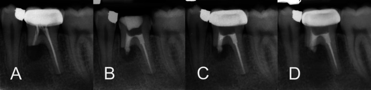 Simplified Orthograde Apical Plug and Intra-Orifice Barriers for Resolving a Complex Endodontic Challenge: A Case Report.