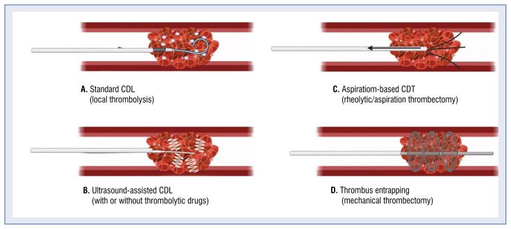 Catheter-directed therapy to treat intermediateand high-risk pulmonary embolism: Personal experience and review of the literature.