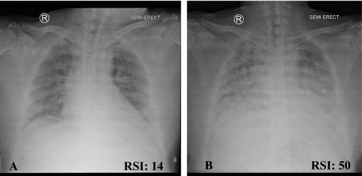 The chest X-ray radiologic severity index as a determinant of the severity of COVID-19 pneumonia: study based on the duration of treatment and inpatient rooms.