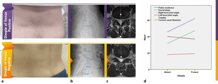 Dimple of Venus Is Associated with the Increased Pelvic Incidence Angle and More Sagittally Oriented Facet Joint.