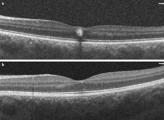 Idiopathic Unilateral Foveal Hemorrhage in a Young Woman Without Precipitating Factors: Evaluation with Optical Coherence Tomography Angiography.