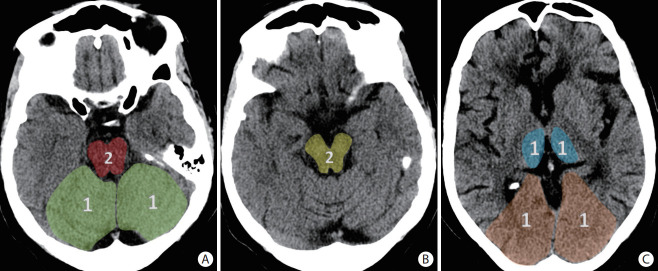 Neuroimaging of Acute Ischemic Stroke: Multimodal Imaging Approach for Acute Endovascular Therapy.