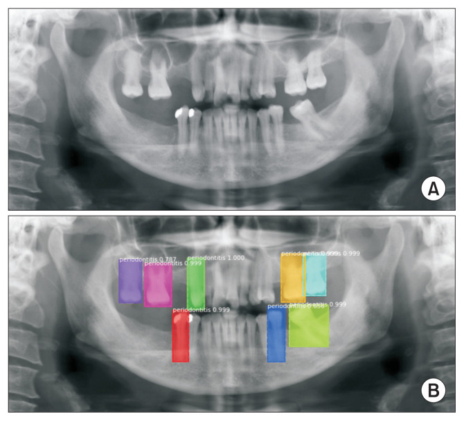 Clinical Decision Support System for Geriatric Dental Treatment Using a Bayesian Network and a Convolutional Neural Network.