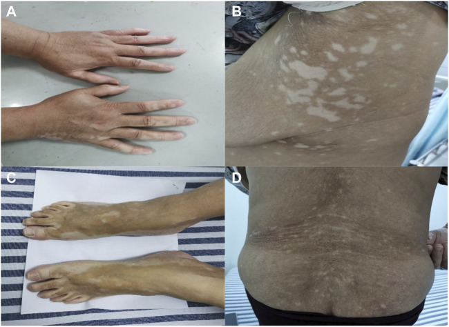 Vitiligo-like lesions induced by cyclin-dependent kinase 4/6 inhibitor Palbociclib: a case report and literature review.