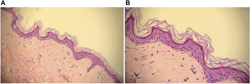 Vitiligo-like lesions induced by cyclin-dependent kinase 4/6 inhibitor Palbociclib: a case report and literature review.