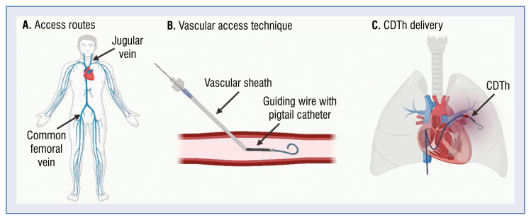 Catheter-directed therapy to treat intermediateand high-risk pulmonary embolism: Personal experience and review of the literature.