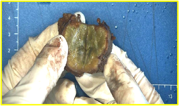 Indolent T-lymphoblastic proliferation with fibrolamellar hepatocellular carcinoma developed after colorectal adenocarcinoma: a case report.