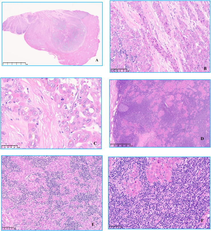 Indolent T-lymphoblastic proliferation with fibrolamellar hepatocellular carcinoma developed after colorectal adenocarcinoma: a case report.