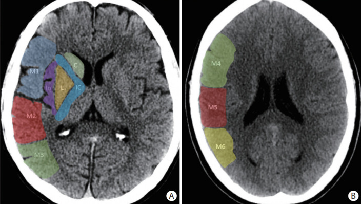 Neuroimaging of Acute Ischemic Stroke: Multimodal Imaging Approach for Acute Endovascular Therapy.