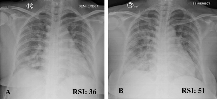 The chest X-ray radiologic severity index as a determinant of the severity of COVID-19 pneumonia: study based on the duration of treatment and inpatient rooms.