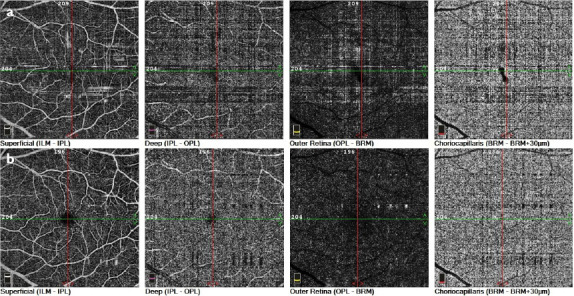 Idiopathic Unilateral Foveal Hemorrhage in a Young Woman Without Precipitating Factors: Evaluation with Optical Coherence Tomography Angiography.