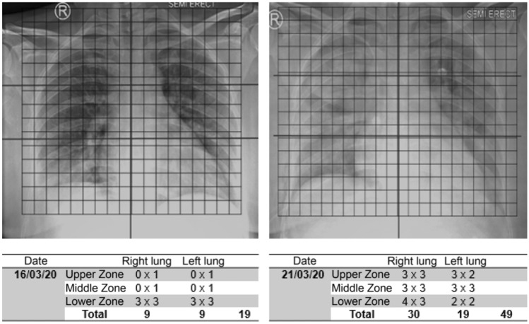 The chest X-ray radiologic severity index as a determinant of the severity of COVID-19 pneumonia: study based on the duration of treatment and inpatient rooms.