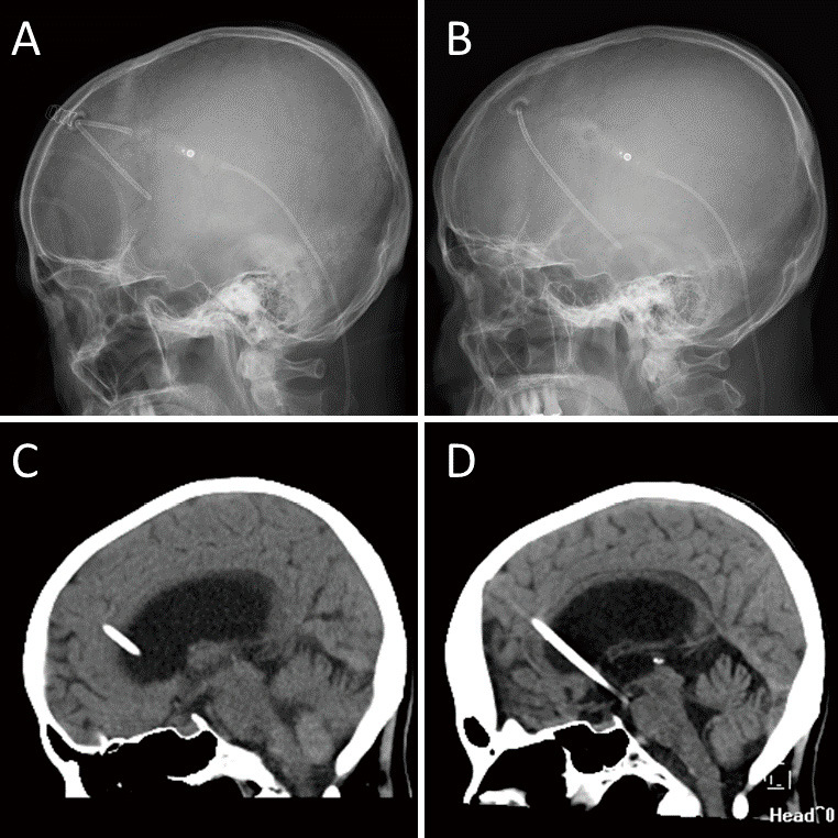 Ventriculoperitoneal Shunt Failure 3-year after Shunt Surgery Caused by Migration of Detached Ventricular Catheter into the Cranium: A Case Study of Idiopathic Normal-pressure Hydrocephalus.