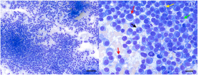 Myelomatous pleural effusion in a cat diagnosed with multiple myeloma.