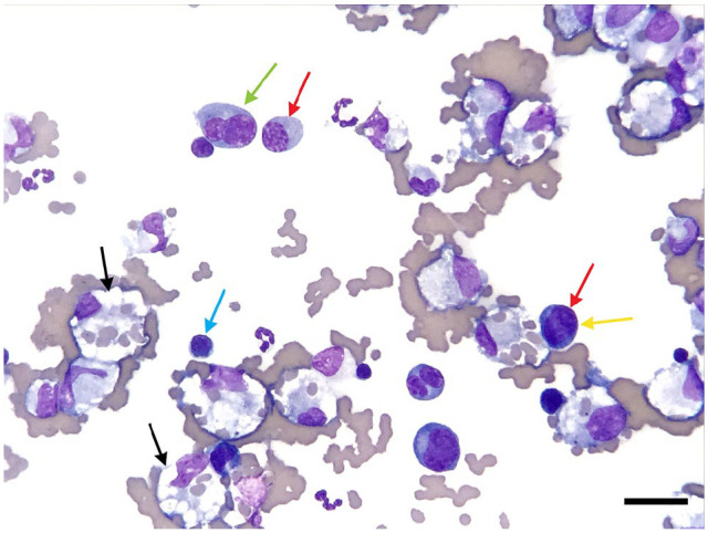 Myelomatous pleural effusion in a cat diagnosed with multiple myeloma.