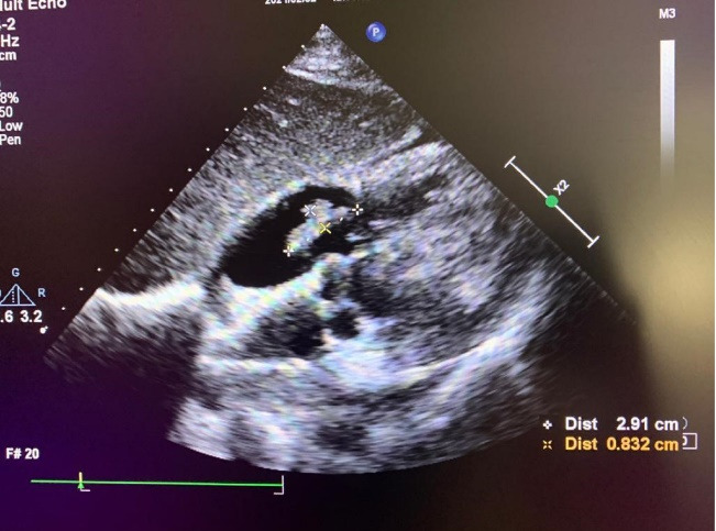 Infective Endocarditis as a complication of COVID-19 infection; A case report and review of literature.