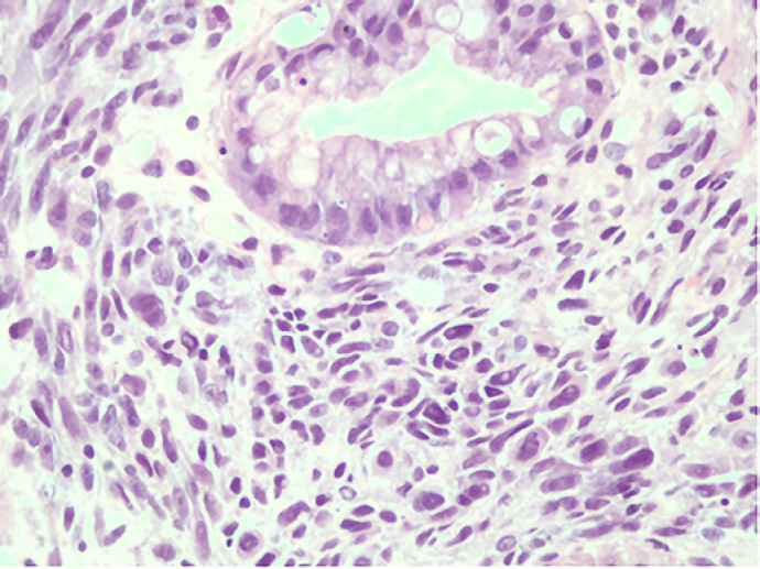 Gastric Metastatic Melanoma Mimicking a Hyperplastic Lesion.