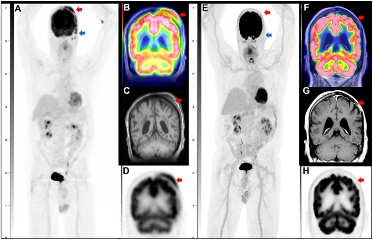 Successful CNS-Centric Therapeutic Management and Genomic Profiling of Primary Cranial Vault Diffuse Large B-Cell Lymphoma.