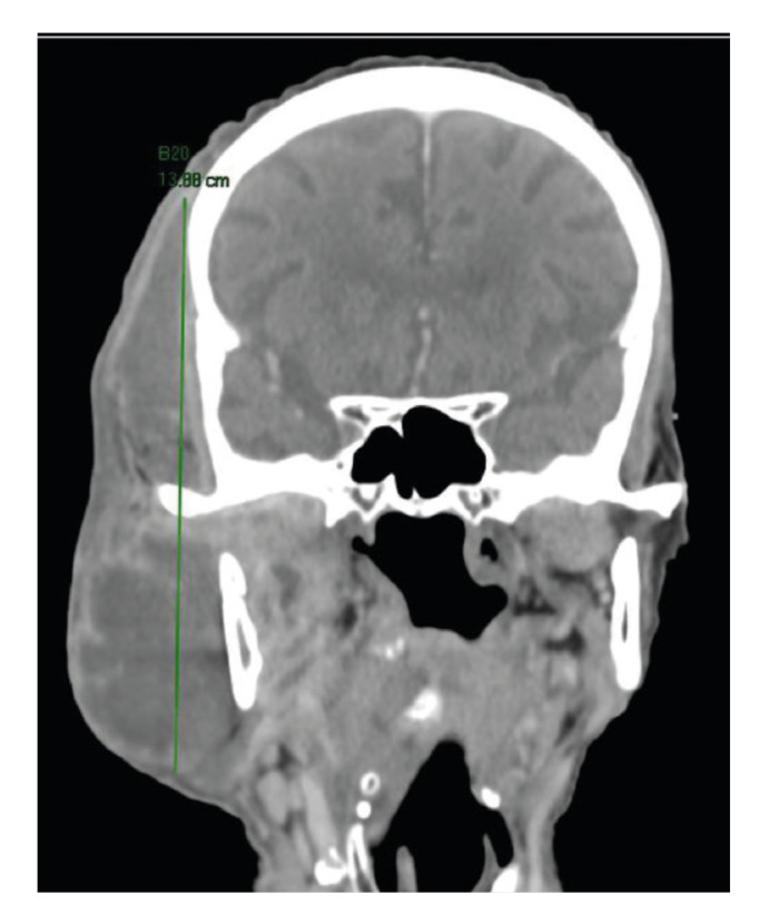 Role of early extraction of odontogenic focus in deep neck infections.