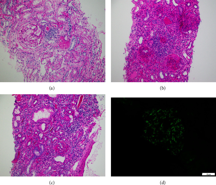 Blind Spot in the Radar of MEST-C Score: Type and Severity of Tubulointerstitial Nephritis in IgA Nephropathy.