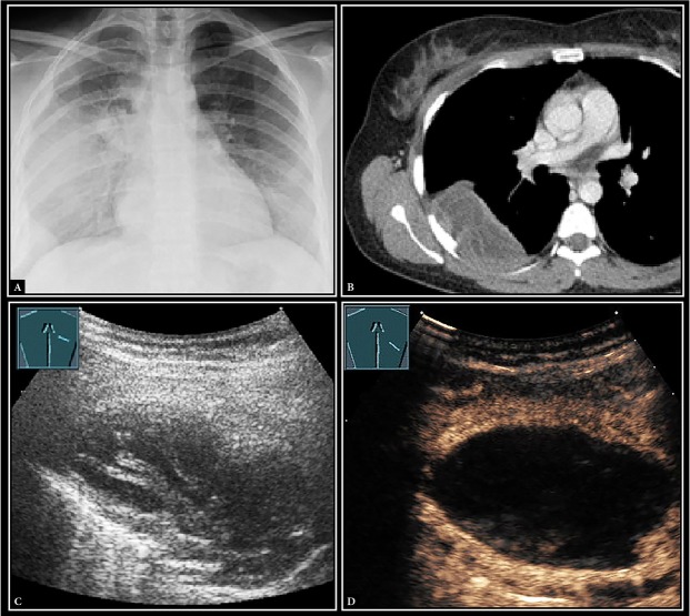 Pulmonary Cystic Echinococcosis in Contrast-enhanced Ultrasound - A Case Report.