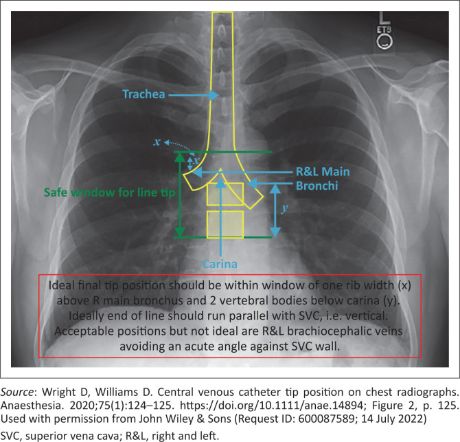 Comparison between ultrasound and chest X-ray to confirm central venous catheter tip position.