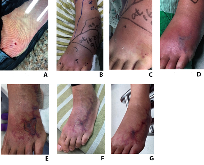 Taiwan cobra envenoming: serum venom concentration before and after specific treatment and relationship with debridement of necrotic wound tissue.