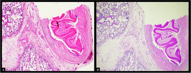 Pulmonary Cystic Echinococcosis in Contrast-enhanced Ultrasound - A Case Report.