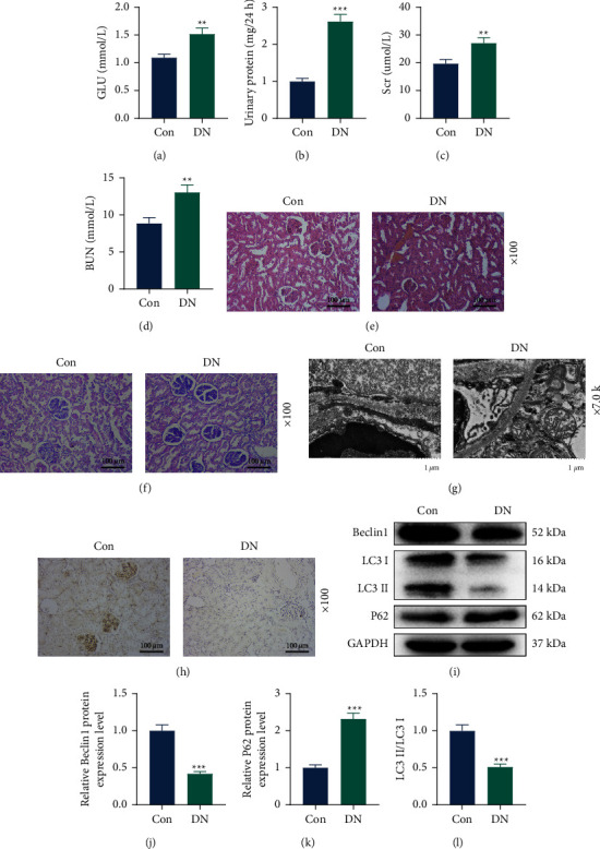 LncRNA X Inactive Specific Transcript Exerts a Protective Effect on High Glucose-Induced Podocytes by Promoting the Podocyte Autophagy via miR-30d-5p/BECN-1 Axis.