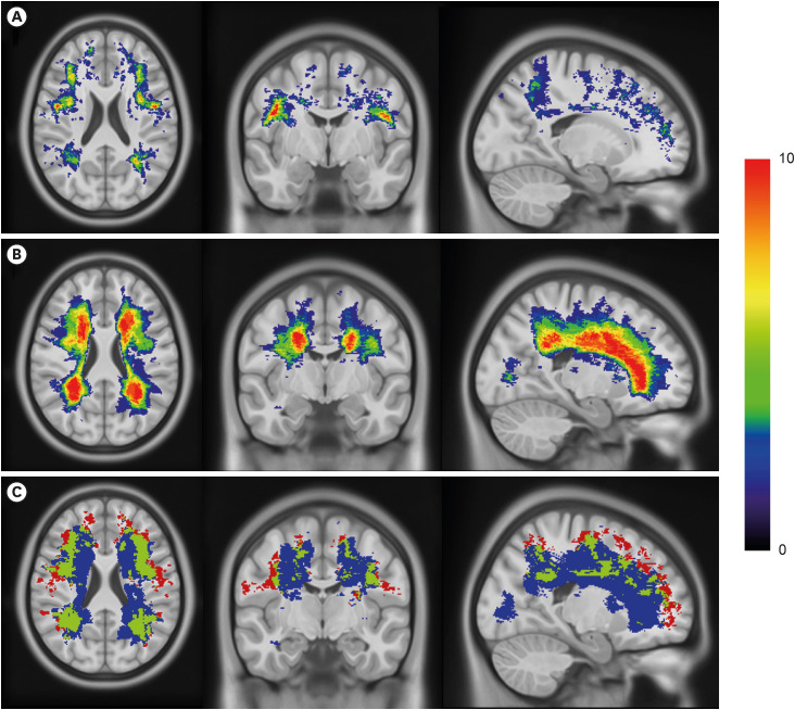 White Matter Lesions Predominantly Located in Deep White Matter Represent Embolic Etiology Rather Than Small Vessel Disease.