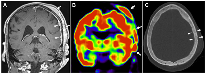 Successful CNS-Centric Therapeutic Management and Genomic Profiling of Primary Cranial Vault Diffuse Large B-Cell Lymphoma.