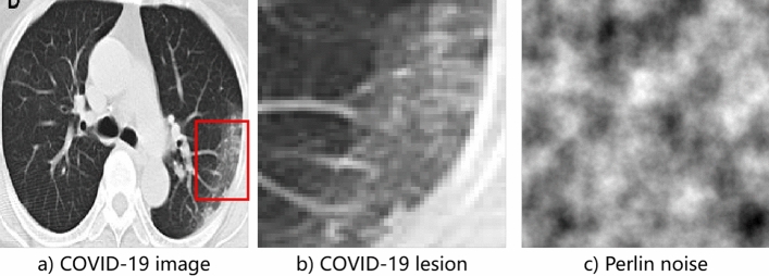 Learning from pseudo-lesion: a self-supervised framework for COVID-19 diagnosis.