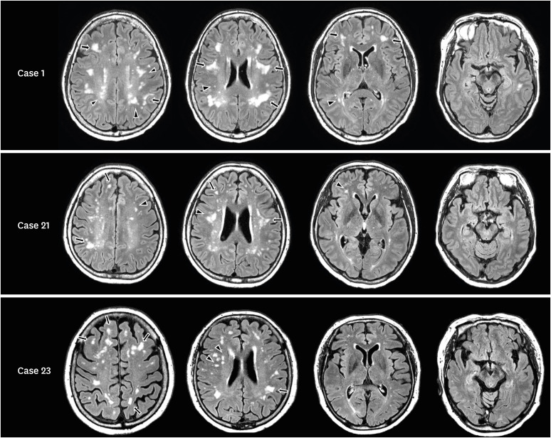 White Matter Lesions Predominantly Located in Deep White Matter Represent Embolic Etiology Rather Than Small Vessel Disease.