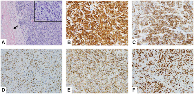 Successful CNS-Centric Therapeutic Management and Genomic Profiling of Primary Cranial Vault Diffuse Large B-Cell Lymphoma.