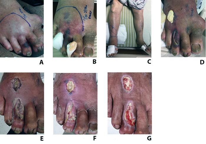 Taiwan cobra envenoming: serum venom concentration before and after specific treatment and relationship with debridement of necrotic wound tissue.