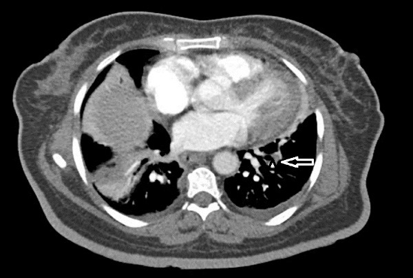 Infective Endocarditis as a complication of COVID-19 infection; A case report and review of literature.