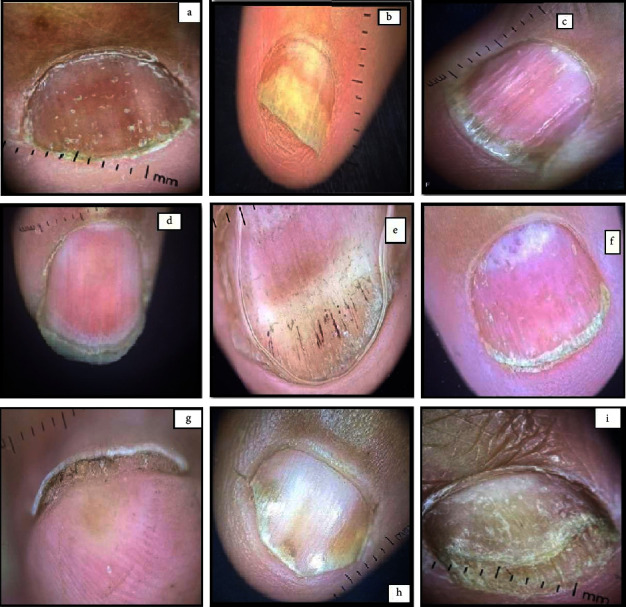 Dermoscopic Features of Psoriatic Nails and Their Correlation to Disease Severity.