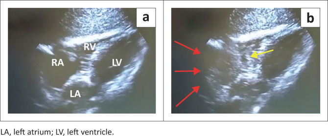 Comparison between ultrasound and chest X-ray to confirm central venous catheter tip position.