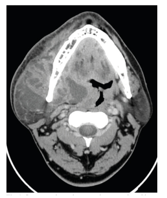 Role of early extraction of odontogenic focus in deep neck infections.