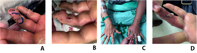 Taiwan cobra envenoming: serum venom concentration before and after specific treatment and relationship with debridement of necrotic wound tissue.