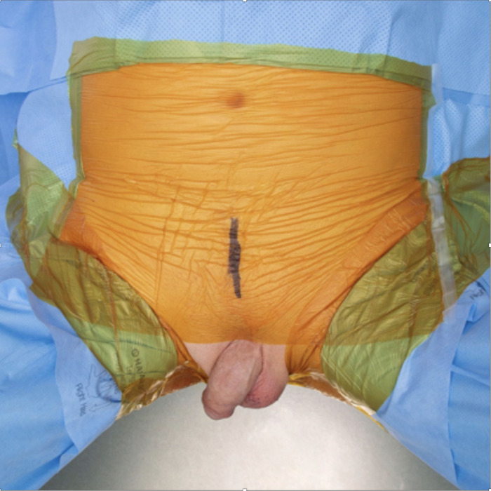 The "Minimal-Touch" Technique for Artificial Urinary Sphincter Placement: Description and Outcomes.