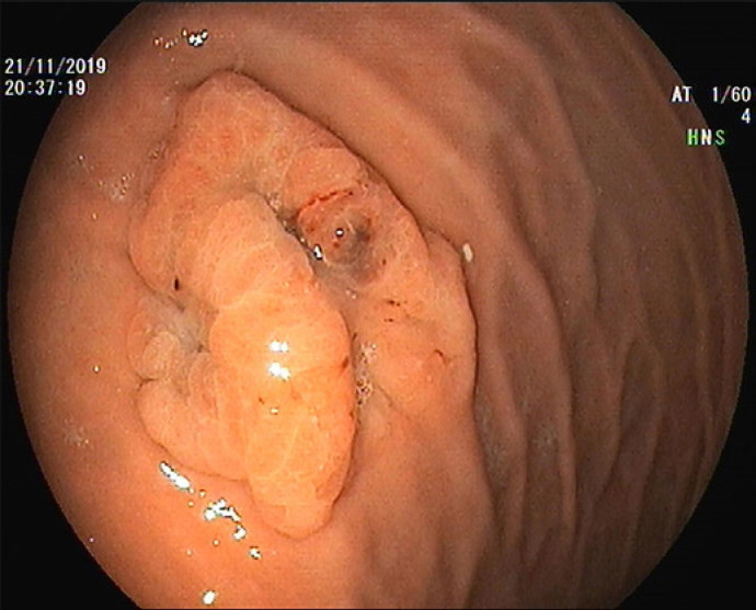 Gastric Metastatic Melanoma Mimicking a Hyperplastic Lesion.