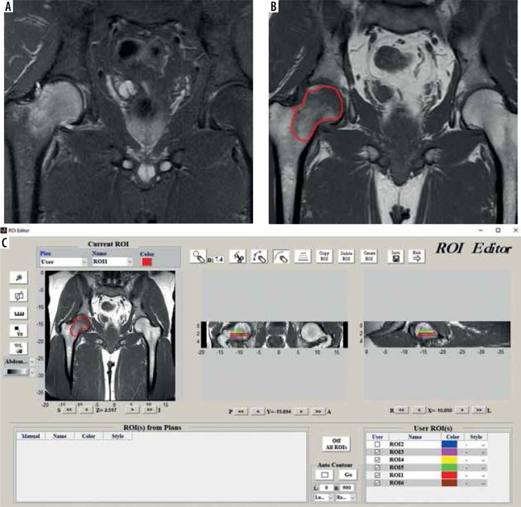 Bone marrow lesions of the femoral head: can radiomics distinguish whether it is reversible?