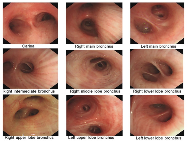 Distinguishing bronchoscopically observed anatomical positions of airway under by convolutional neural network.