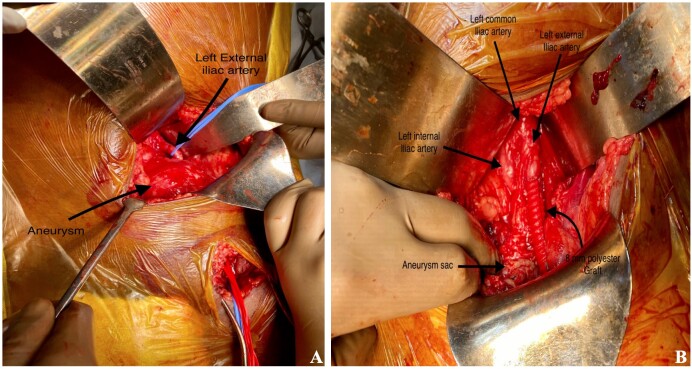 Isolated external iliac artery aneurysm: a rare case presentation of IgG4-related disease.